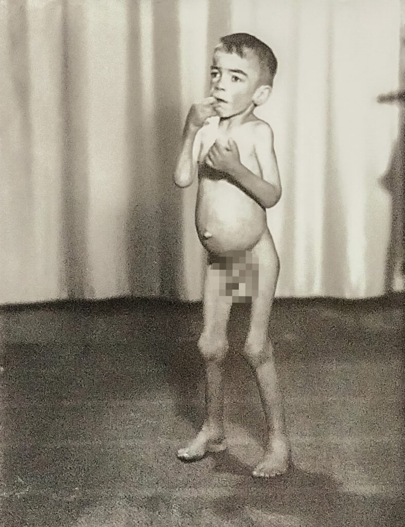 Es ist ein schwarz-weißes Foto. Zu sehen ist ein nackter Junge. Er ist unterernährt. Sein Bauch ist aufgebläht. Seine Gelenke stechen hervor. Seine Haare sind kurz. Er scheint unsicher zu stehen und hat eine Hand am Mund. Hinter ihm ist ein Bühnenvorhang zu erkennen.